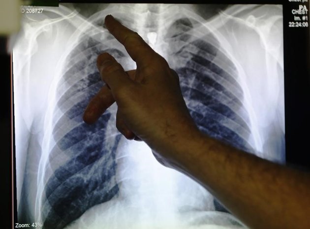 L'OMS alerte sur le niveau élevé de tuberculoses multirésistantes