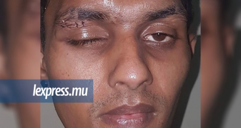 Nasiir Mamade Dulull, 30 ans, a été blessé à l’œil avec un coup-de-poing américain.