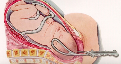 Le forceps est un instrument métallique qui permet de saisir la tête du fœtus.