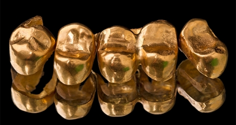 Les dents en métal sont une mine d’or d’informations pour l’ICAC