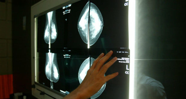 Certains cancers du sein présentent un risque de rechute pendant 20 ans (étude)